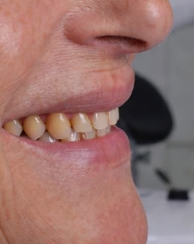 Full Arch Transformation - Before