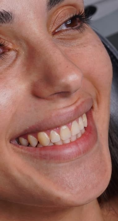 Veneer Enhancement - Before